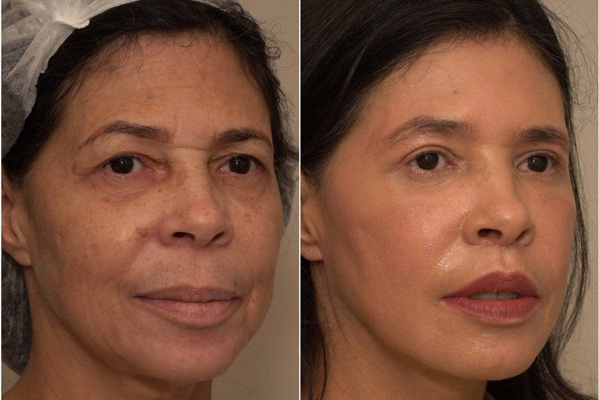 Peeling de Fenol - Antes e Depois | Focalizando